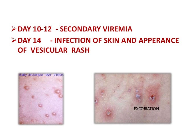 chicken pox photos chicken pox causes